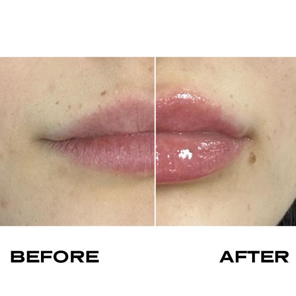 Plump It! No Needles Lip Filler Kit: Lip Builders