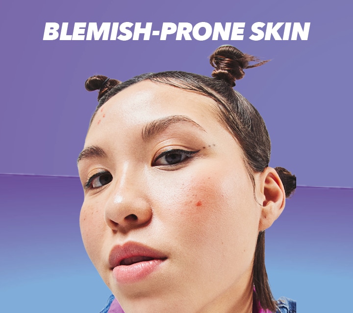 Acnecide_plp_shopbyskin_Carousel_Blemish