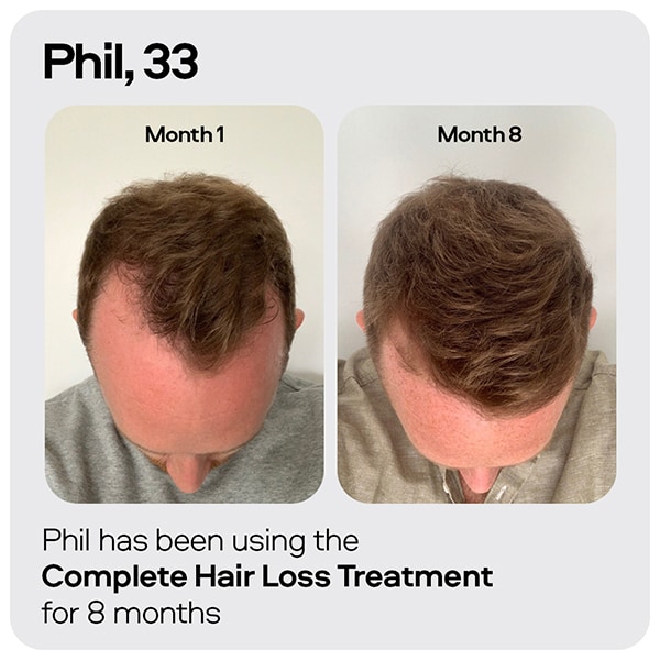 Sons Hair Regrowth Minoxidil 5% for Male Pattern Hair Loss