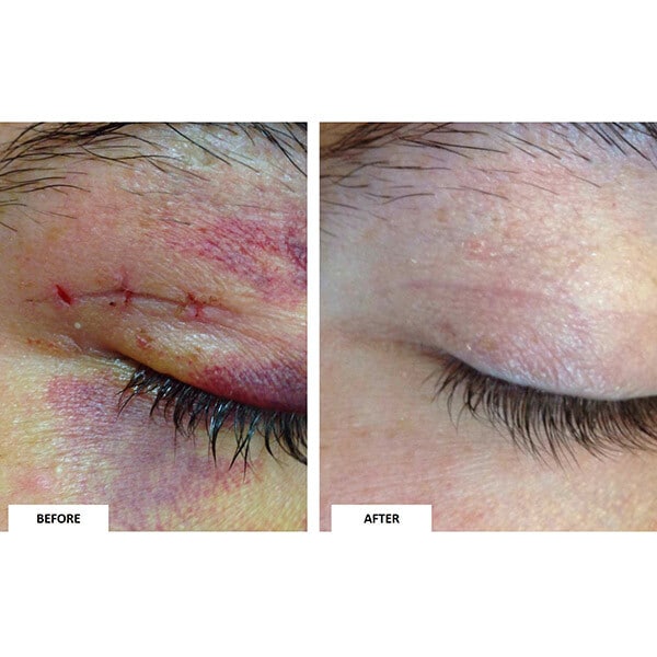 KELO-COTE Clinically Proven Silicone Scar Gel UV 15g