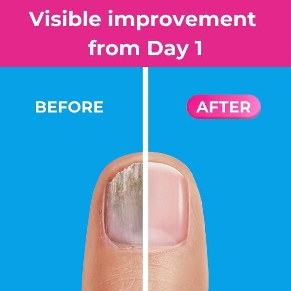 Excilor Ultra Nail Fungus Treatment