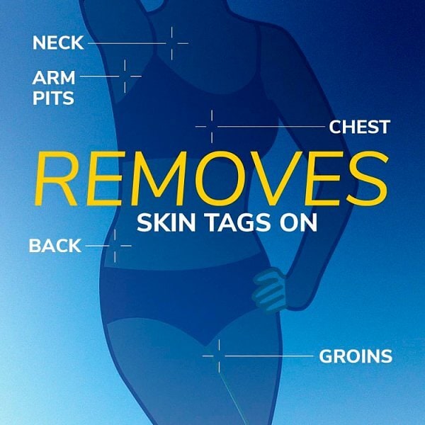 Scholl Freeze Away Skin Tag Remover
