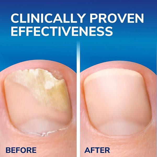 Dr. Scholl's Fungal Nail 2 in 1 Treat & Shield 3.8ml