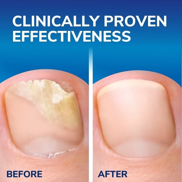 Dr. Scholl’s Bundle Fungal Nail Treatment System & Antifungal spray