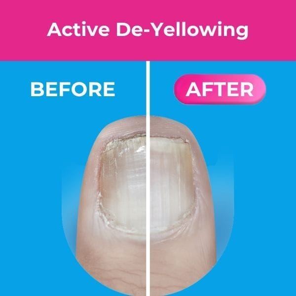 Excilor Nail Fungus Easy Pen