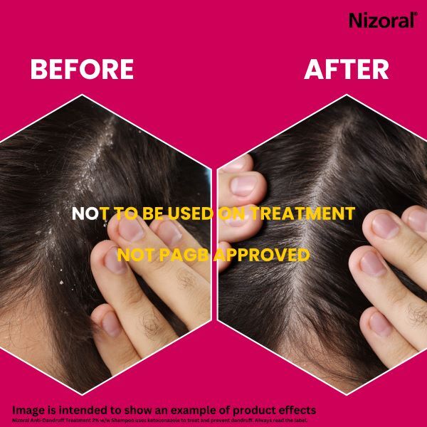 Nizoral Anti-dandruff Shampoo 60ml