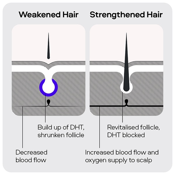 Sons Hair Regrowth Minoxidil 5% for Male Pattern Hair Loss