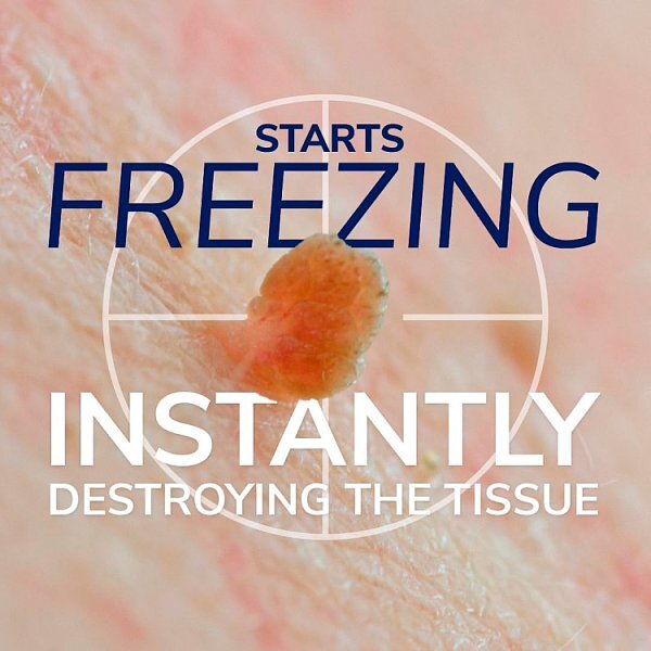 Scholl Freeze Away Skin Tag Remover