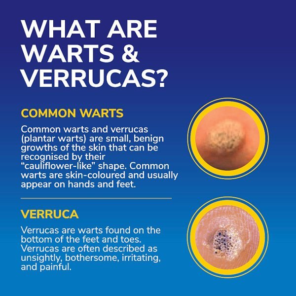 Dr. Scholl's Freeze Away Max Wart & Verruca Remover