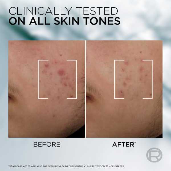 L'Oréal Men Expert Derma Control Anti-Blemish Serum 3% Niacinamide