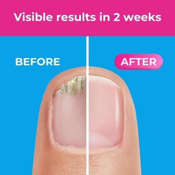 Excilor Solution 3.3ml