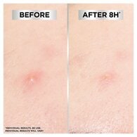 Garnier Pure Active Blemish Patch 22 Pack
