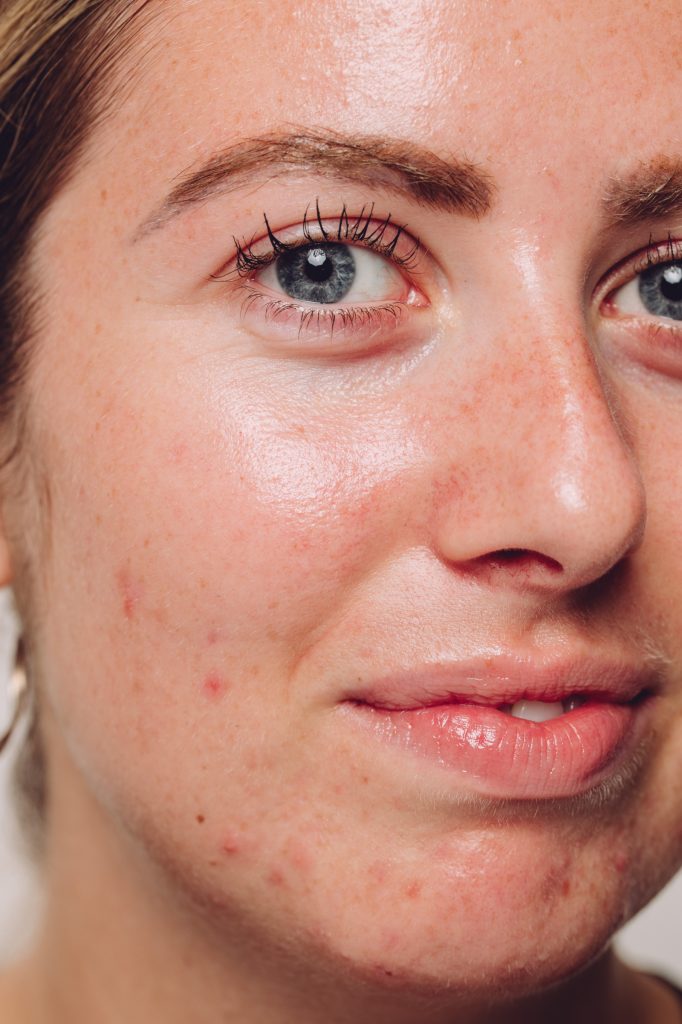 close up of female face with acne