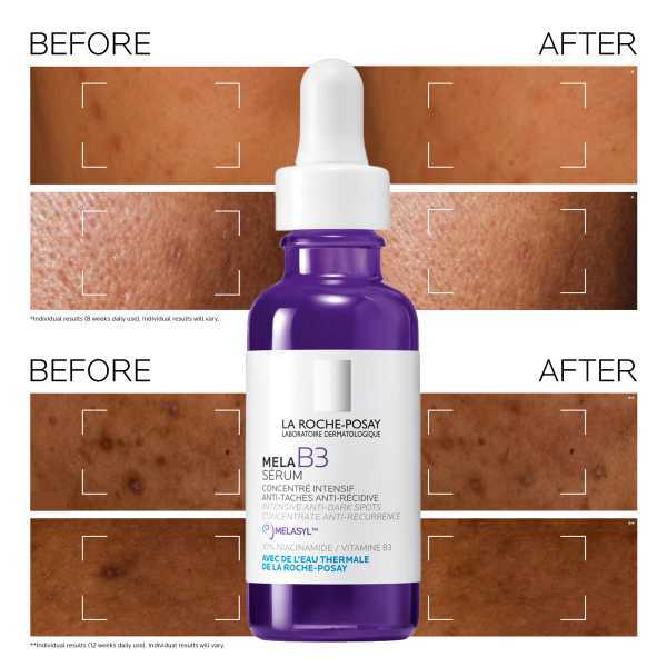 La Roche-Posay Mela B3 Intensive Anti-Dark Spot Correcting Serum – 30mL (1 Fl Oz), SPF 30